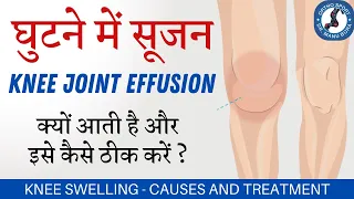 घुटने में सूजन #Knee Joint #Effusion क्यों आती है, कैसे ठीक करें? Knee Swelling Causes and Treatment