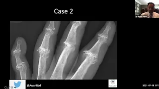 How to diagnose arthritis on X-rays?  #education #radedu #medicaleducation