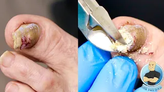 SUPER THICK TOENAIL TRIMMING AND FILING