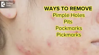 Pits, pockmarks, pick marks, permanent holes on face | BEST TREATMENT-Dr. Nischal K| Doctors' Circle