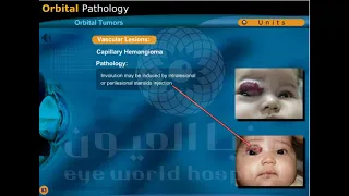 orbital tumors