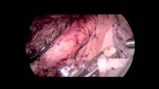 Laparoscopic Lateral Pancreaticojejunostomy