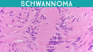 Schwannoma (explained in 5 minutes) Verocay bodies Antoni A & B usmle nerve sheath tumor pathology