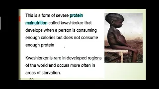 Kwashiorkor #A protein deficiency disease.