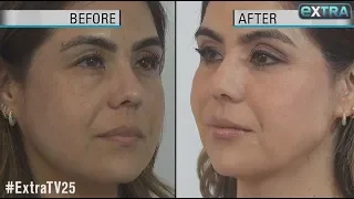 How to Get a Quick Face-Lift Without Surgery