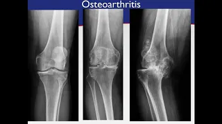Part 1 - Hip & Knee Arthritis Webinar Series: Knee Osteoarthritis