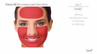 Fotona 4D Non-Invasive Laser Facelift