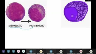 Leucemia Mielóide Crônica e Aguda