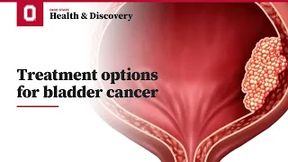 Treatment options for bladder cancer  | Ohio State Medical Center