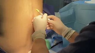 Anestesia epidural por catéter