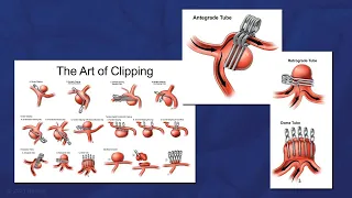 Complex Clipping of an Anterior Communicating Artery Aneurysm