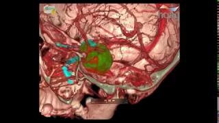 Next Gen Imaging Preop Plan & Surgical Navigation 3D Virtual Reality Guidance for Pituitary Surgery