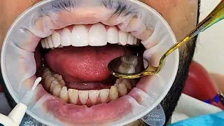 بدون نحت الأسنان إبتسامة هوليود بتقنية النانو فينير No Teeth Drilling Hollywood Smile  د عزالدين