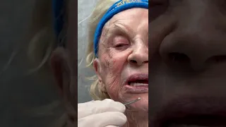 2 Cysts Incised & Drained from a 100 year Old at Las Vegas Dermatology