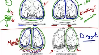 multiple pregnancy