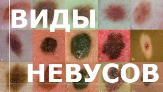 Невусы - виды невусов, причины и лечение