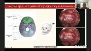 How to resect intra-orbital tumors:a view from neurosurgeon/Dr. Hud Wei (Harvey), MD,PhD