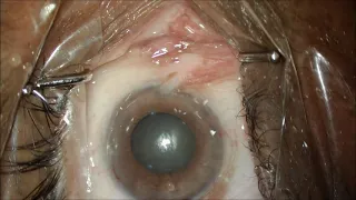 Intracameral T plus ultra, keeps pupil dilated throughout the procedure.