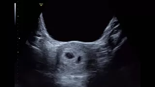 How Early Can You See Twins On A Scan?