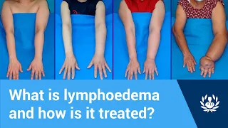 What is lymphoedema and how is it treated?