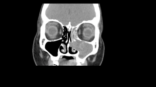 Maxillary sinonasal polyp - coronal soft tissue