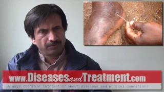 Dracunculiasis (Guinea Worm Disease) : Causes, Diagnosis, Symptoms, Treatment, Prognosis