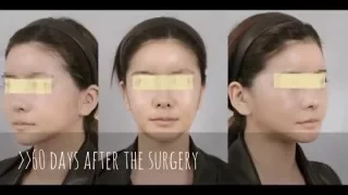 Plastic Surgery of Mongolian Patient -V line, V3 lifting, cheekbone reduction and rhinoplasty