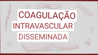 Coagulação intravascular disseminada - causas, sintomas, diagnóstico, tratamento, patologia