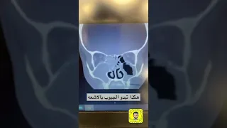 الجيوب الانفيه بالاشعه