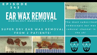 DRY EAR WAX REMOVAL FROM 2 PATIENTS - EP 343