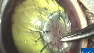 Herida en el ojo de un perro y cirugía de injerto corneal para curar perforación