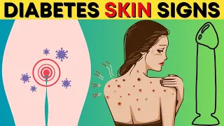 Top 12 Diabetes Skin Signs, Symptoms & Treatment [Type 2 & 1 Diabetes]