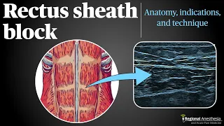 Rectus Sheath Block