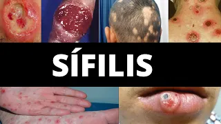 SÍFILIS: Causa, Transmissão, Sintomas, Fases, Diagnóstico, Tratamento, Prevenção