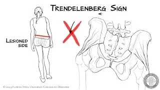 The Trendelenberg Sign [HD]