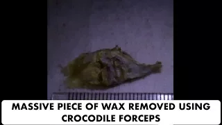 MASSIVE PIECE OF EAR WAX REMOVED USING CROCODILE FORCEPS - Ep 24