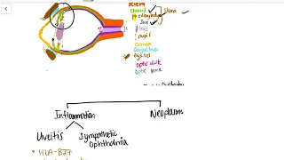 Uvea: Uveitis, Sympathetic Opthalmia,  Melenomas,