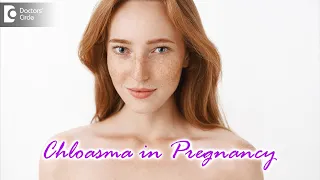 CHLOASMA IN PREGNANCY: What is it? Causes, Symptoms & Treatment - Dr.Aruna Prasad | Doctors' Circle