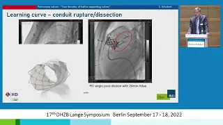 11 Two decades of ballon expanding valves Schubert
