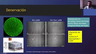 Ojo Seco y Cirugía Refractiva