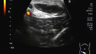 Ultrasound Video showing an Inguinal abscess.