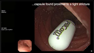 EXTRACTION OF RETAINED VIDEO CAPSULE USING SINGLE BALLOON ENTEROSCOPY