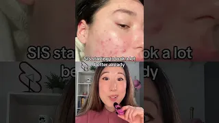 #acne transformation through #accutane; check out my Accutane vid for more info like side effects