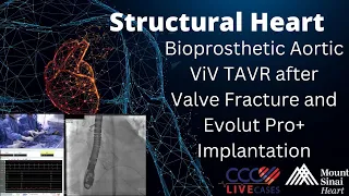 Bioprosthetic Aortic ViV TAVR after Valve Fracture and Evolut Pro+ Implantation