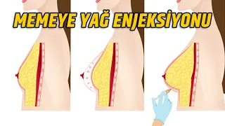 MEMEYİ YAĞ İLE BÜYÜTMEK?! MEMEYE YAĞ TRANSFERİ | Op. Dr. Leyla Arvas