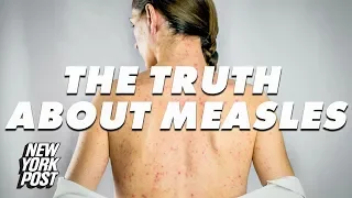 Measles Explained: Everything You Need to Know About The Deadly Virus | New York Post