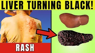 LIVER is Turning BLACK!?!  How Can You Tell? (2024)