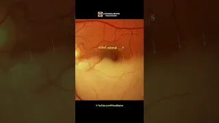 Hemiretinal Artery Occlusion.