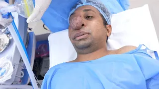 Man with Large Grown Hemangioma in Nose goes under Anesthesia
