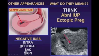 Ultrasound Evaluation of Ectopic Pregnancy